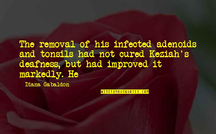 Rebrousser Synonyme Quotes By Diana Gabaldon: The removal of his infected adenoids and tonsils Rebrousser Synonyme Quotes By Diana Gabaldon: The removal of his infected adenoids and tonsils