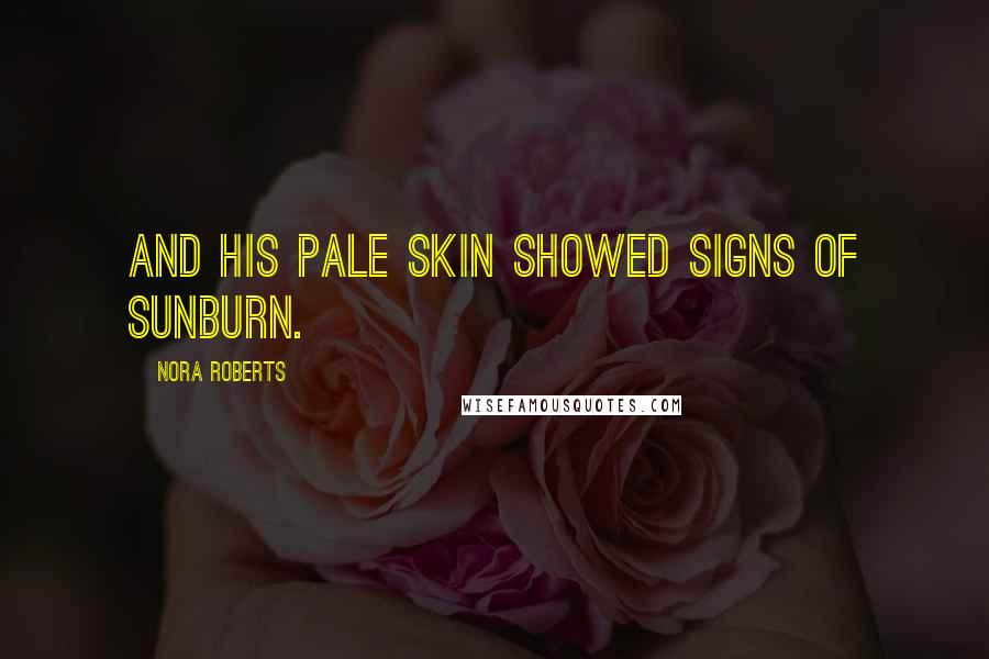 Nora Roberts Quotes: And his pale skin showed signs of sunburn.