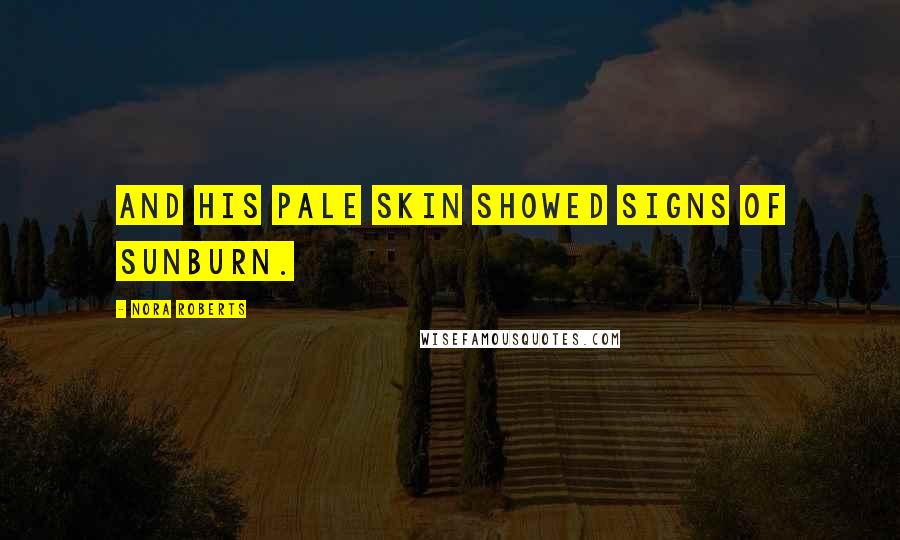 Nora Roberts Quotes: And his pale skin showed signs of sunburn.