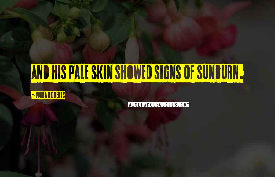 Nora Roberts Quotes: And his pale skin showed signs of sunburn.