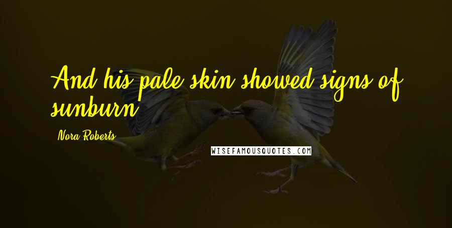Nora Roberts Quotes: And his pale skin showed signs of sunburn.